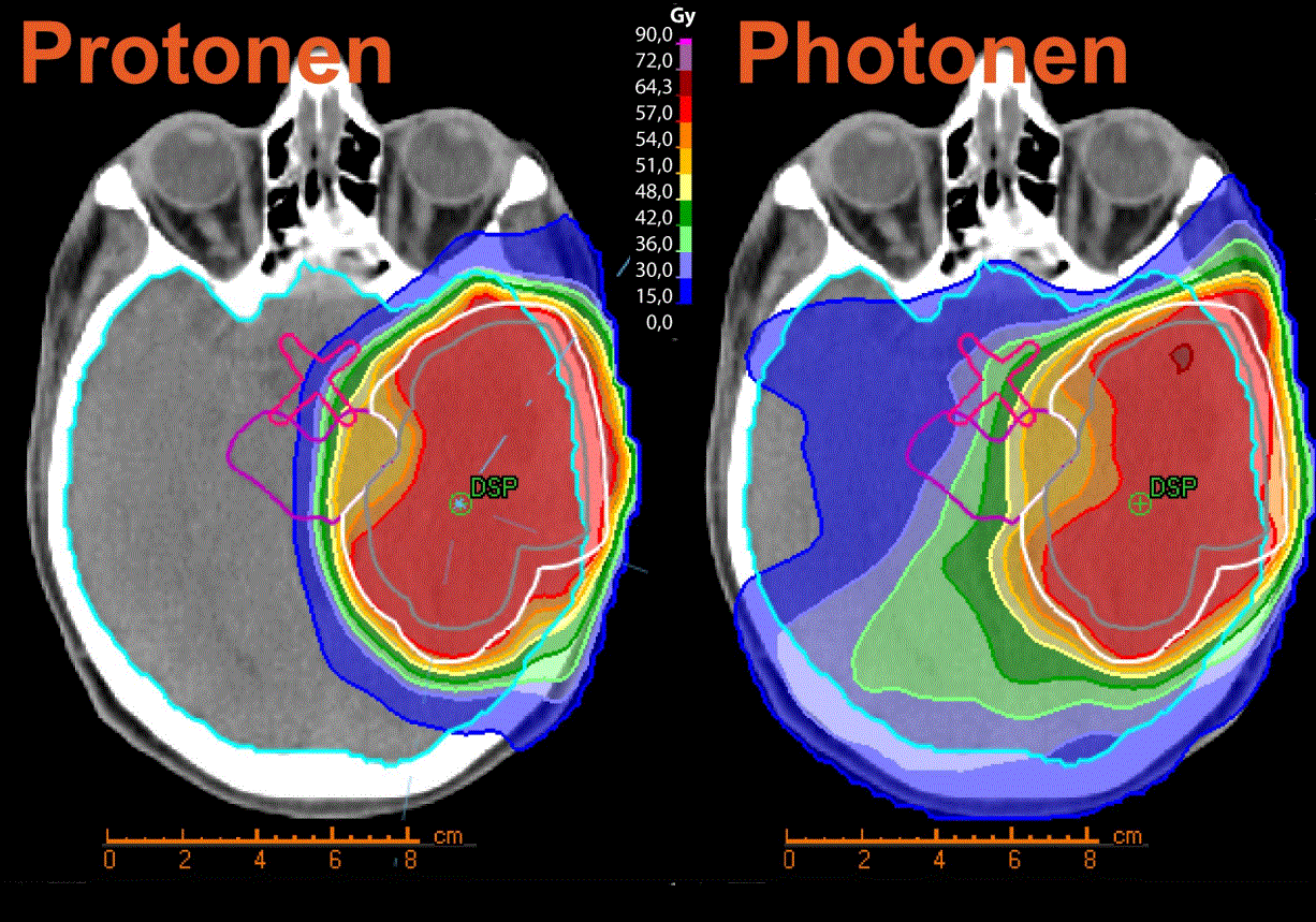 Comparison Proton- and Photon-Therapy