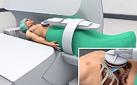 Schematische Darstellung zur Anwendung des fokussierten Ultraschalls im MRT